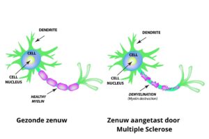 Zenuwaantasting door Multiple Sclerose